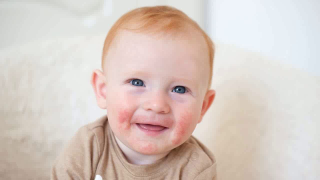 دليل الأبوين للتعامل مع التظاهرات الجلدية عند المواليد الجدد